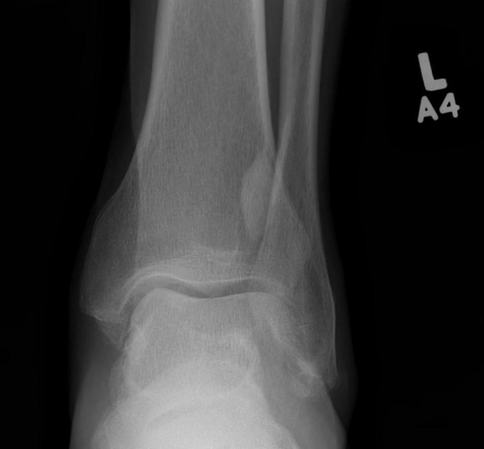 United Non Ossifying Fibroma